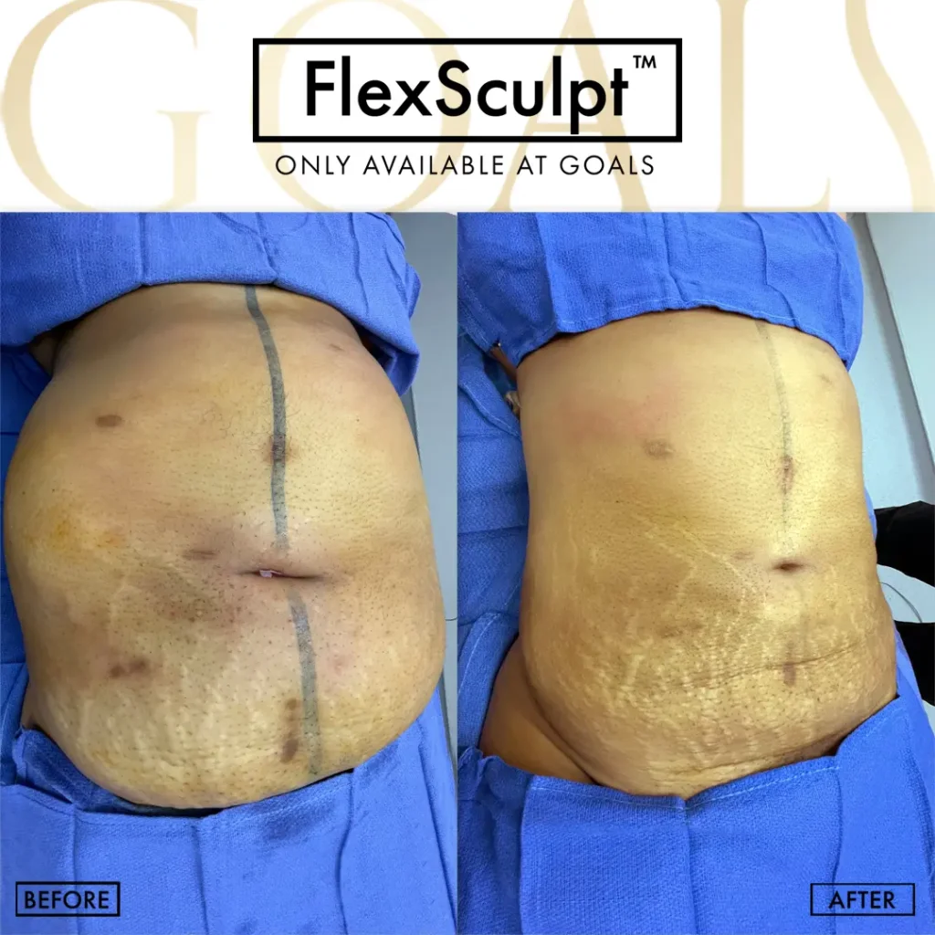 Before and after — Awake Liposuction with FlexSculpt · Harlem, patient 2