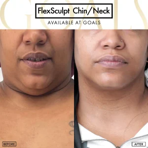 Before and after — Awake Liposuction with FlexSculpt · Harlem, patient 3