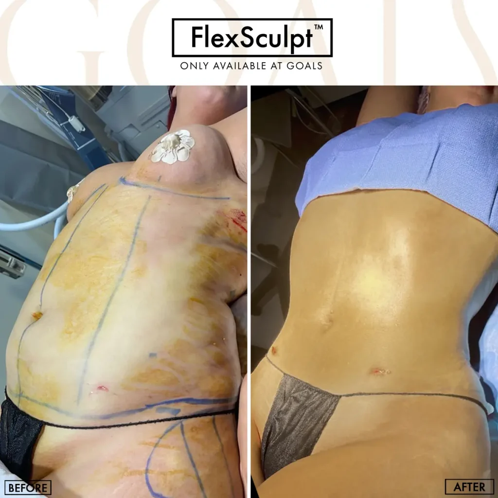 Before and after — Awake Liposuction with FlexSculpt · Bronx, patient 1