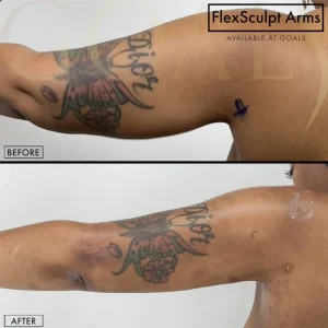 Before and after — Awake Liposuction with FlexSculpt · Bronx, patient 2