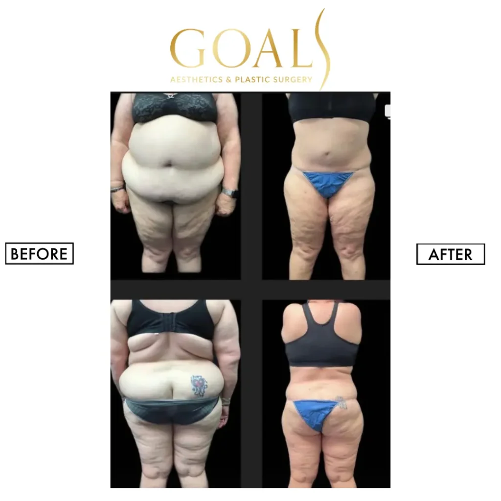 Before and after — Awake Liposuction with FlexSculpt · Bronx, patient 3