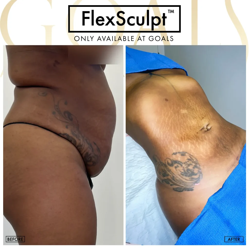 Before and after — Awake Liposuction with FlexSculpt · Bronx, patient 4