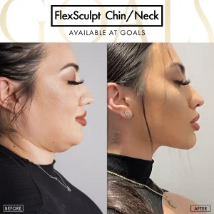 Before and after — Awake Liposuction with FlexSculpt · Bronx, patient 6