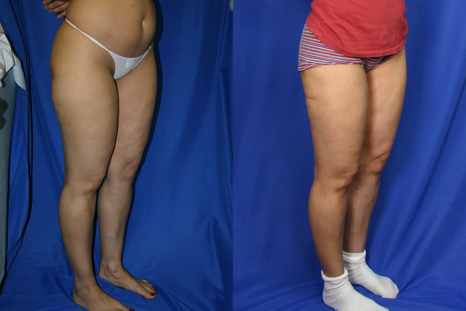 Before and after — Philadelphia, patient 3