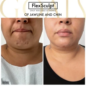 Before and after — Awake Liposuction with FlexSculpt · Gaithersburg, patient 2