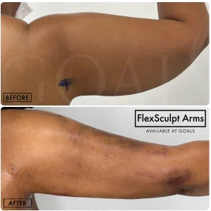Before and after — Awake Liposuction with FlexSculpt · Gaithersburg, patient 3