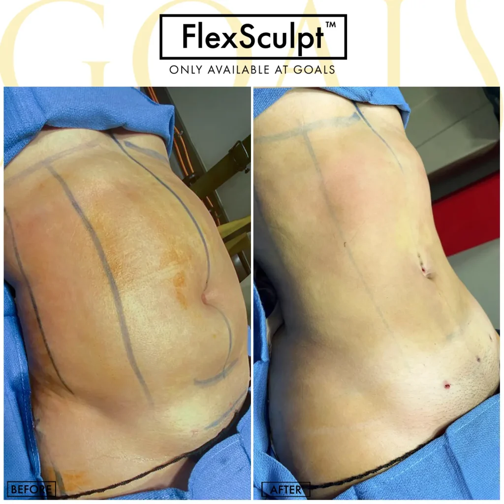 Before and after — Awake Liposuction with FlexSculpt · Gaithersburg, patient 4