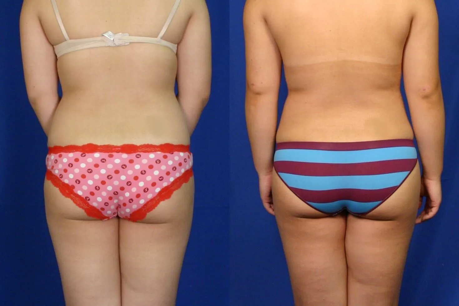 Before and after — Philadelphia, patient 2