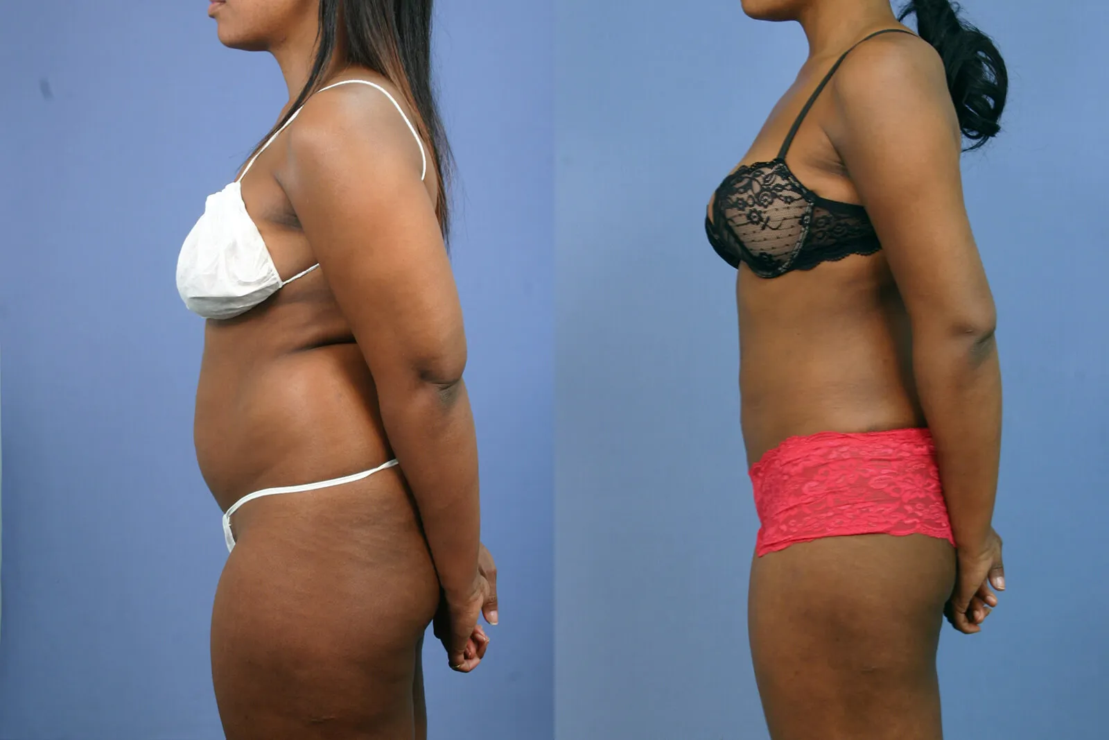 Before and after — Awake Liposuction with FlexSculpt · Gaithersburg, patient 6