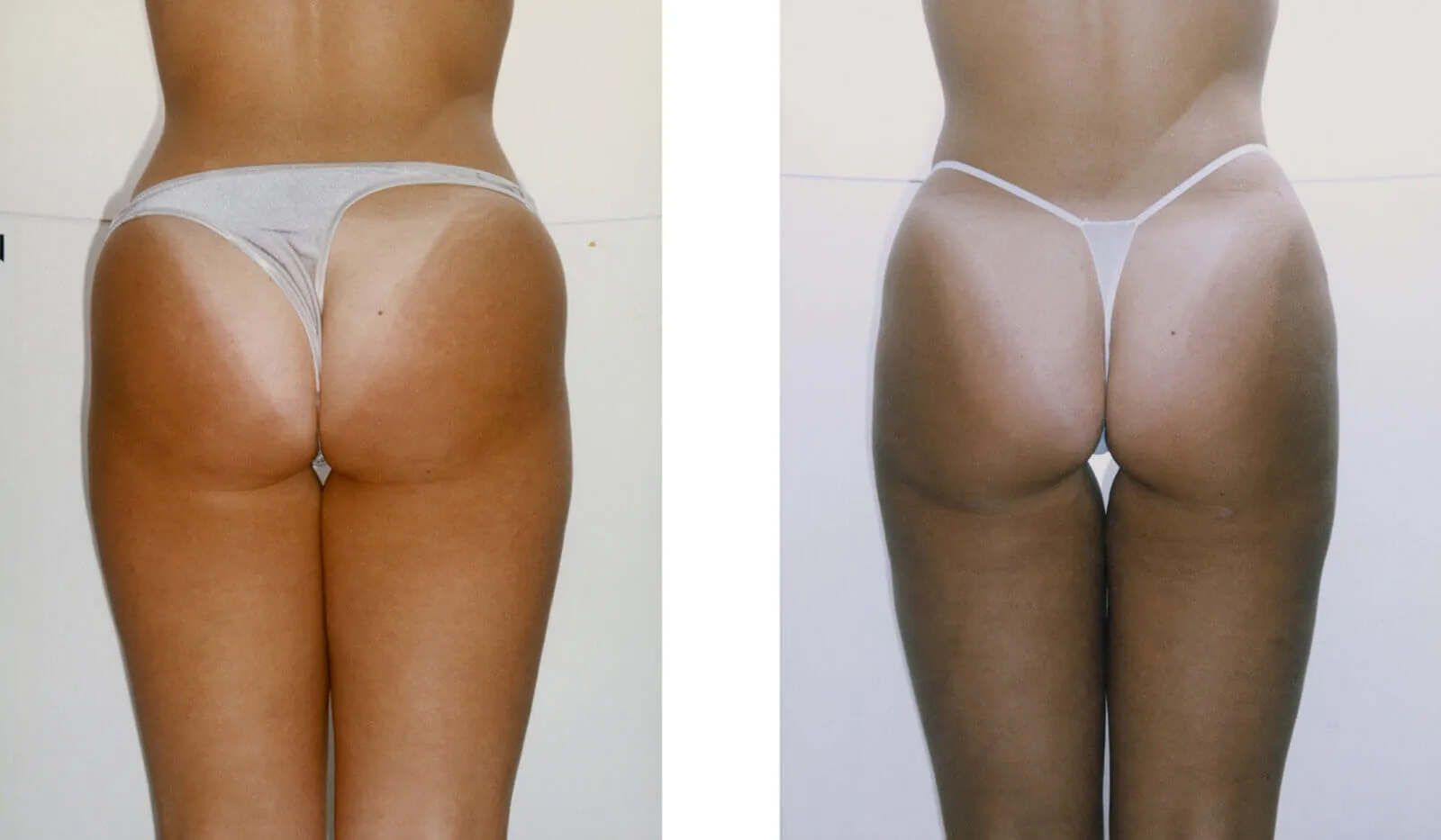 Before and after — Awake Liposuction with FlexSculpt, patient 1