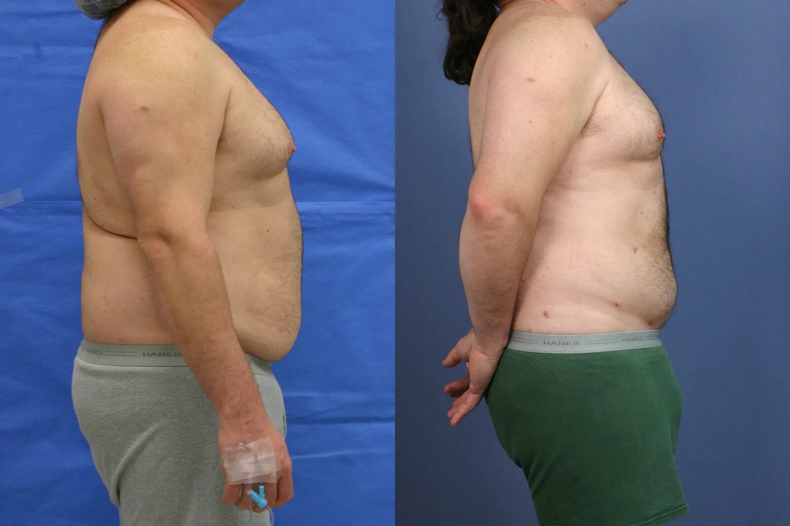 Before and after — Awake Liposuction with FlexSculpt, patient 2