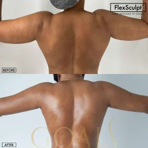 Before and after — Awake Liposuction with FlexSculpt, patient 3