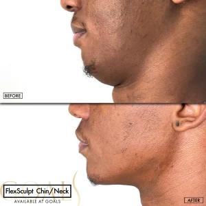 Before and after — Awake Liposuction with FlexSculpt, patient 4