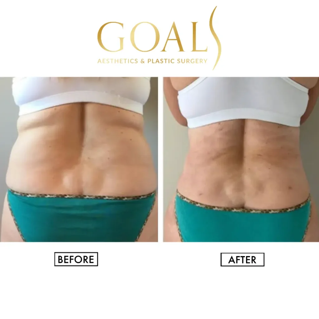 Before and after — Awake Liposuction with FlexSculpt, patient 1
