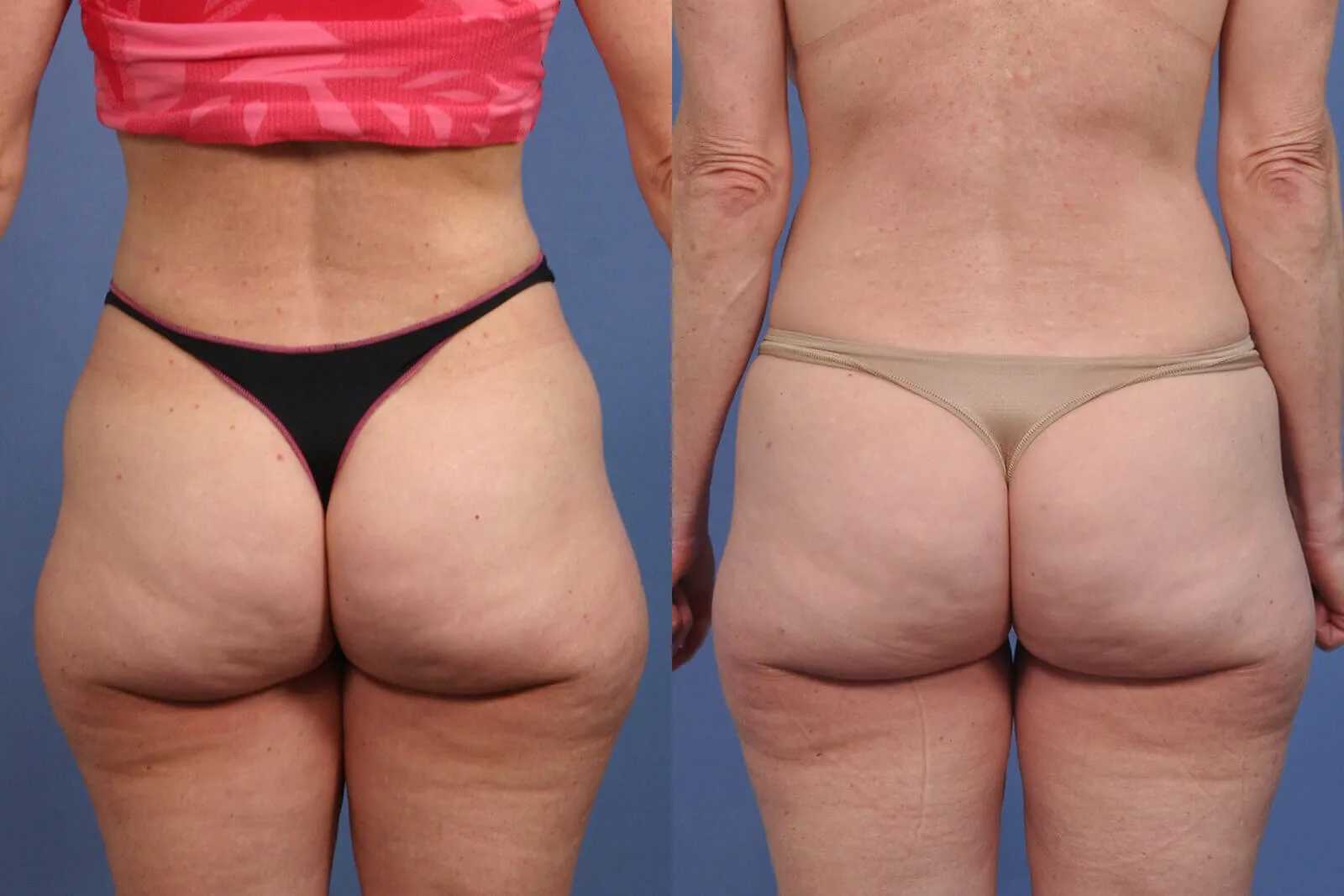Before and after — Awake Liposuction with FlexSculpt, patient 3