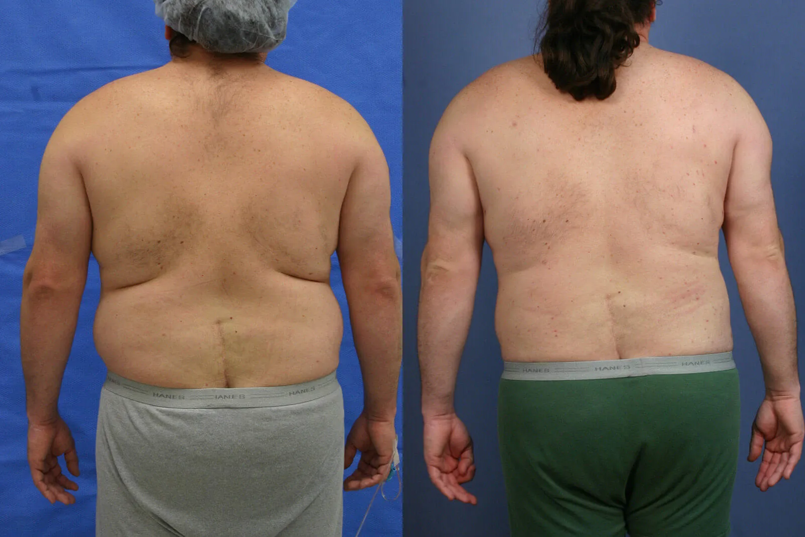 Before and after — Awake Liposuction with FlexSculpt, patient 4