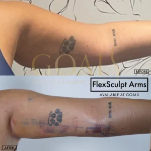 Before and after — Awake Liposuction with FlexSculpt, patient 6