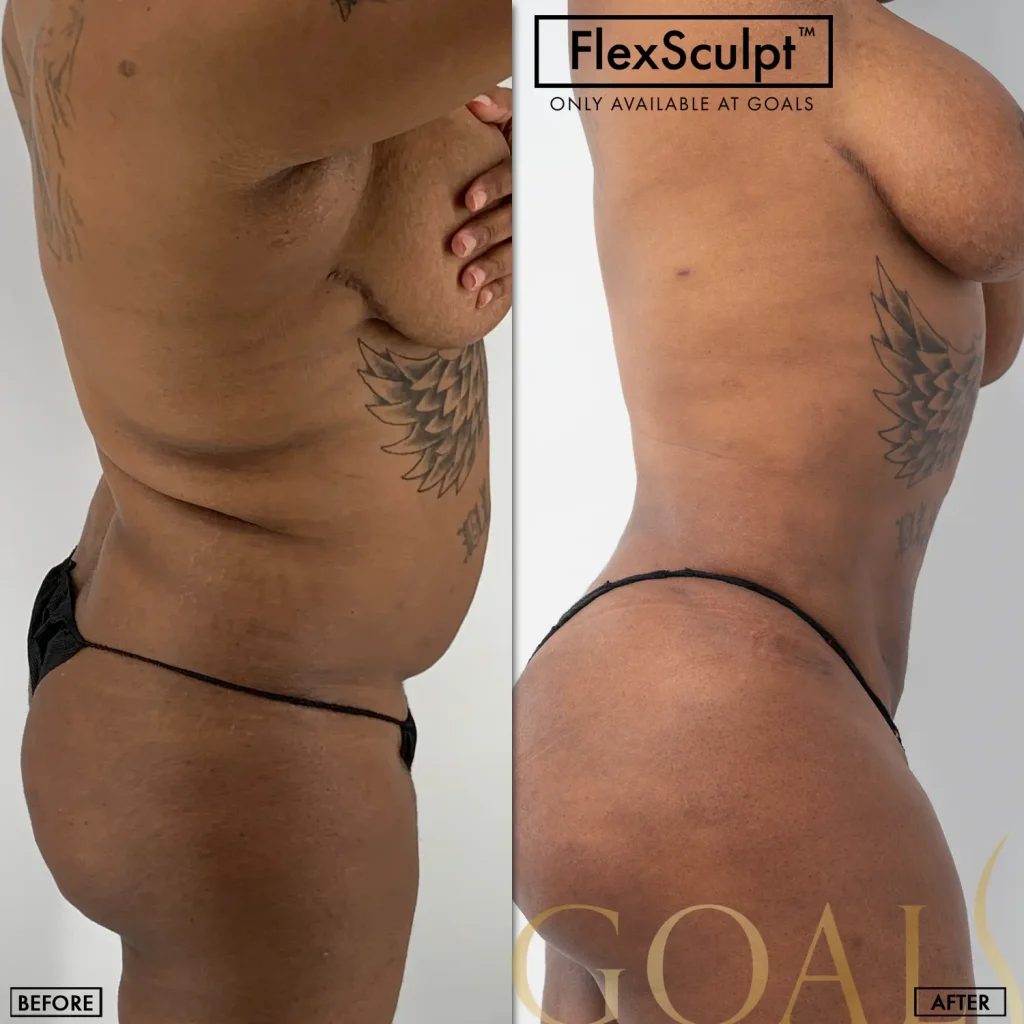 A Goals patient's awake liposuction result