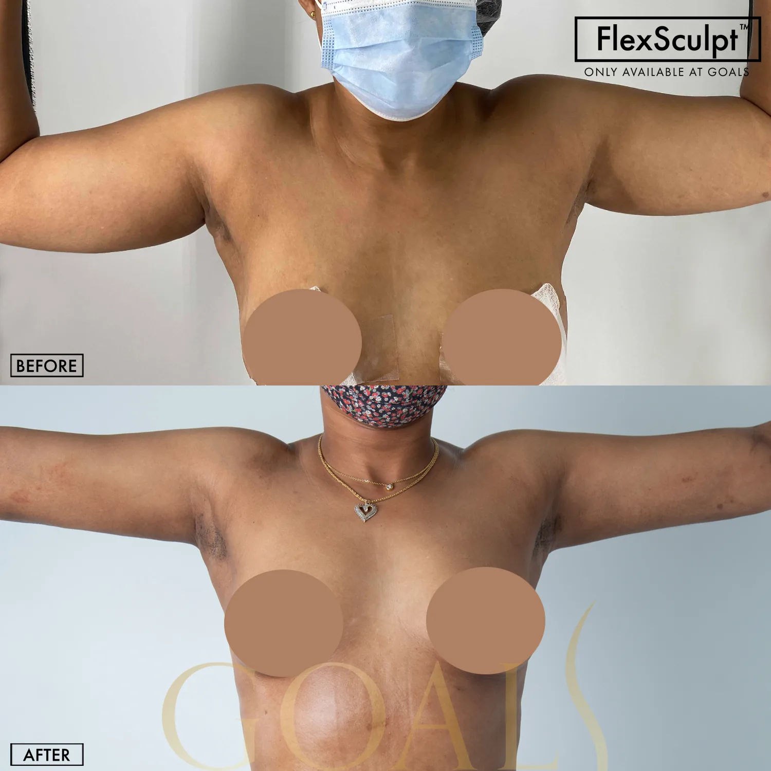 A Goals patient's awake liposuction result