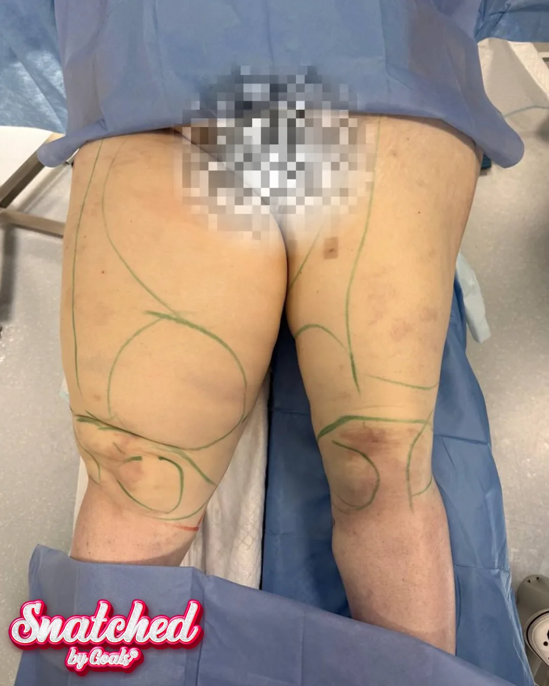 Before and after — Awake Liposuction with FlexSculpt, patient 3