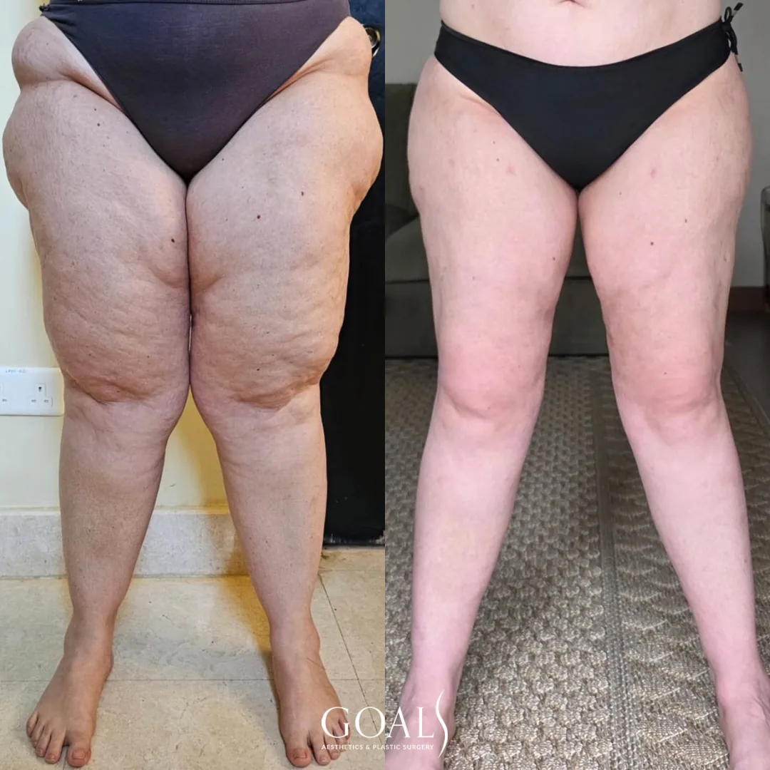 Before and after — Awake Liposuction with FlexSculpt, patient 4