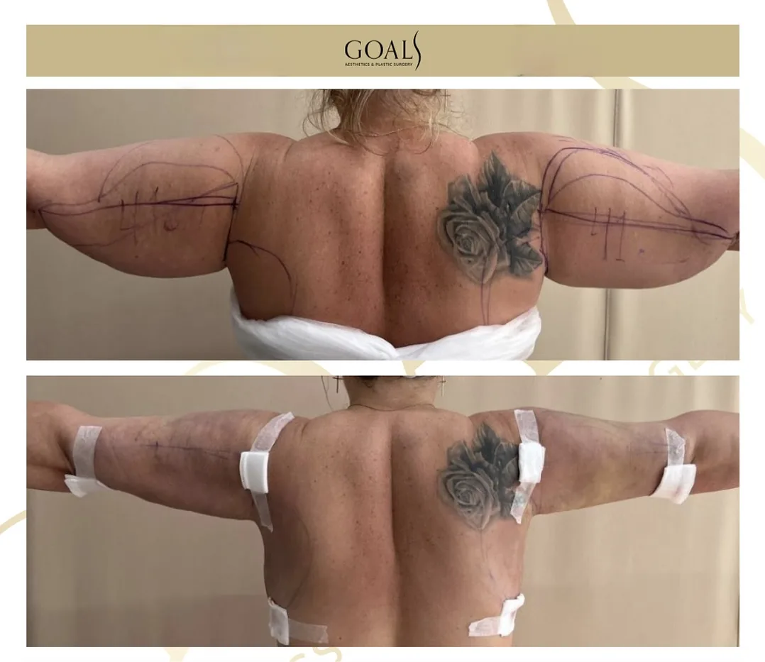 Before and after — Lipoescultura Despierta con FlexSculpt · Atlanta Walton St., patient 1