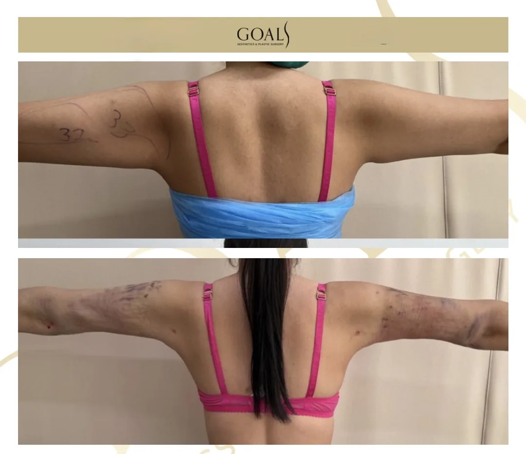 Before and after — Lipoescultura Despierta con FlexSculpt · Atlanta Walton St., patient 2