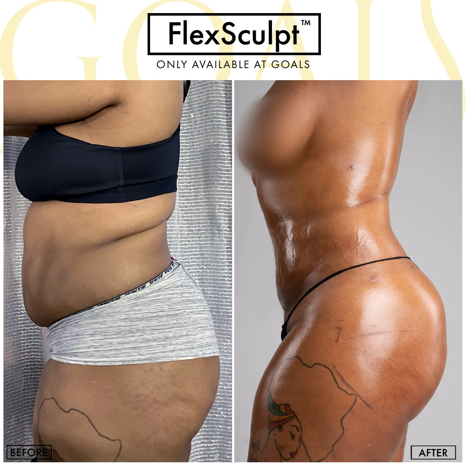 Before and after — Awake Liposuction with FlexSculpt · Los Angeles, patient 1