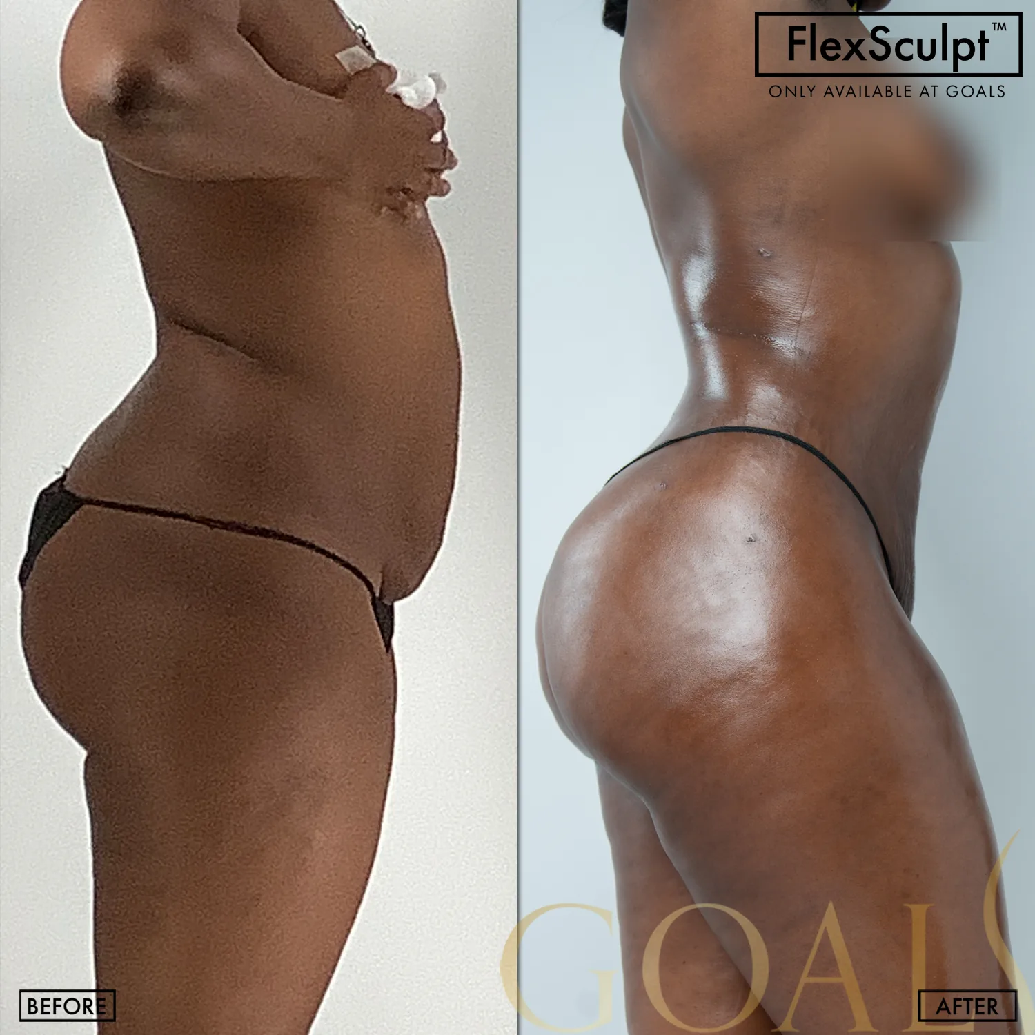 Before and after — Awake Liposuction with FlexSculpt · Los Angeles, patient 2