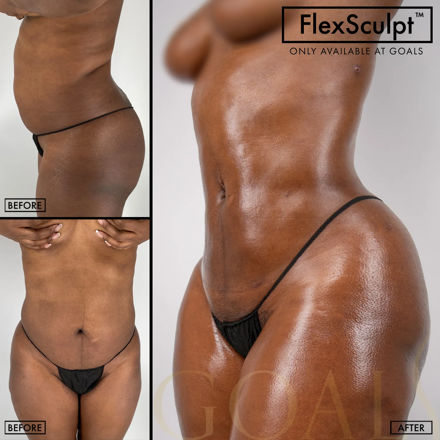 Before and after — Awake Liposuction with FlexSculpt · Los Angeles, patient 3