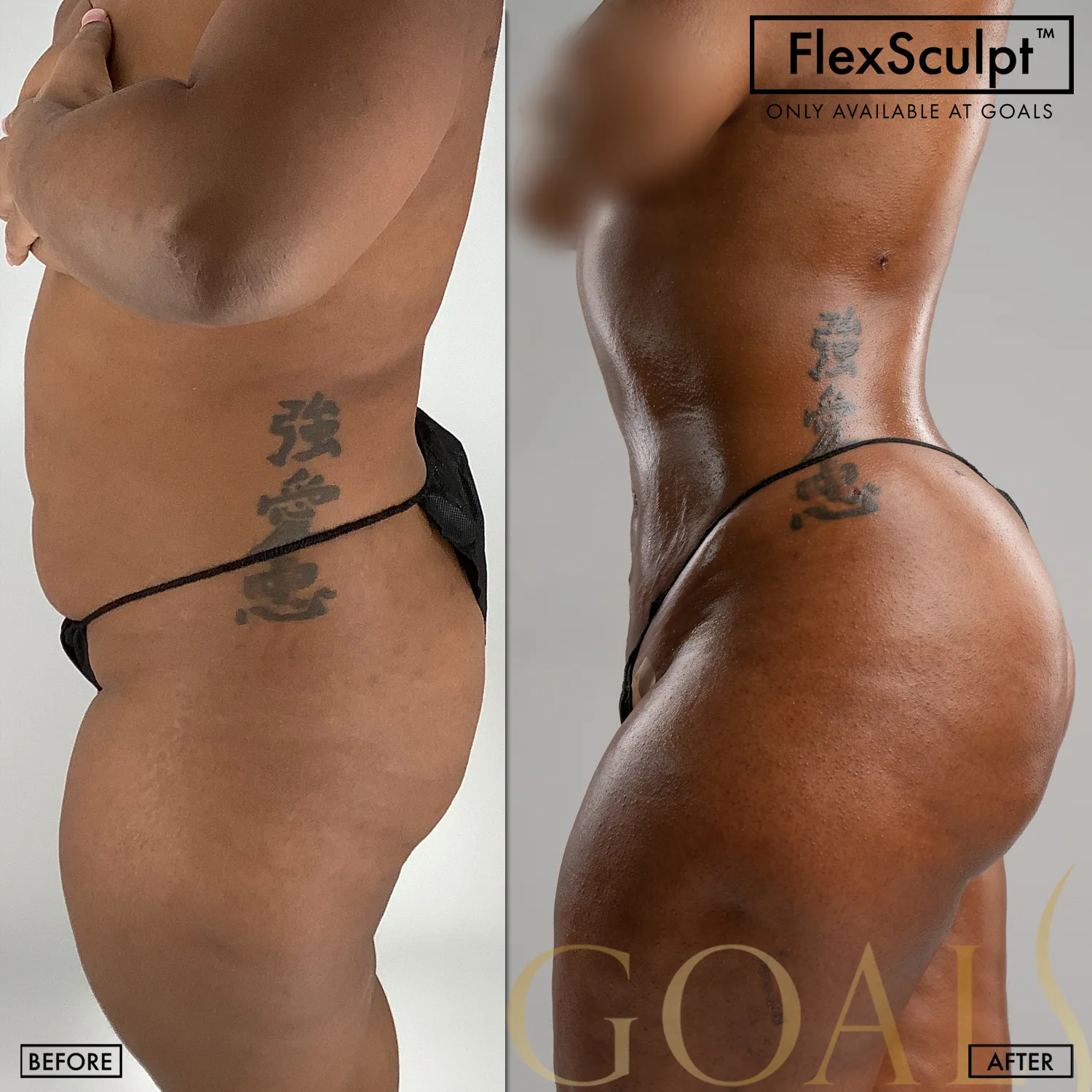 Before and after — Awake Liposuction with FlexSculpt · Los Angeles, patient 4