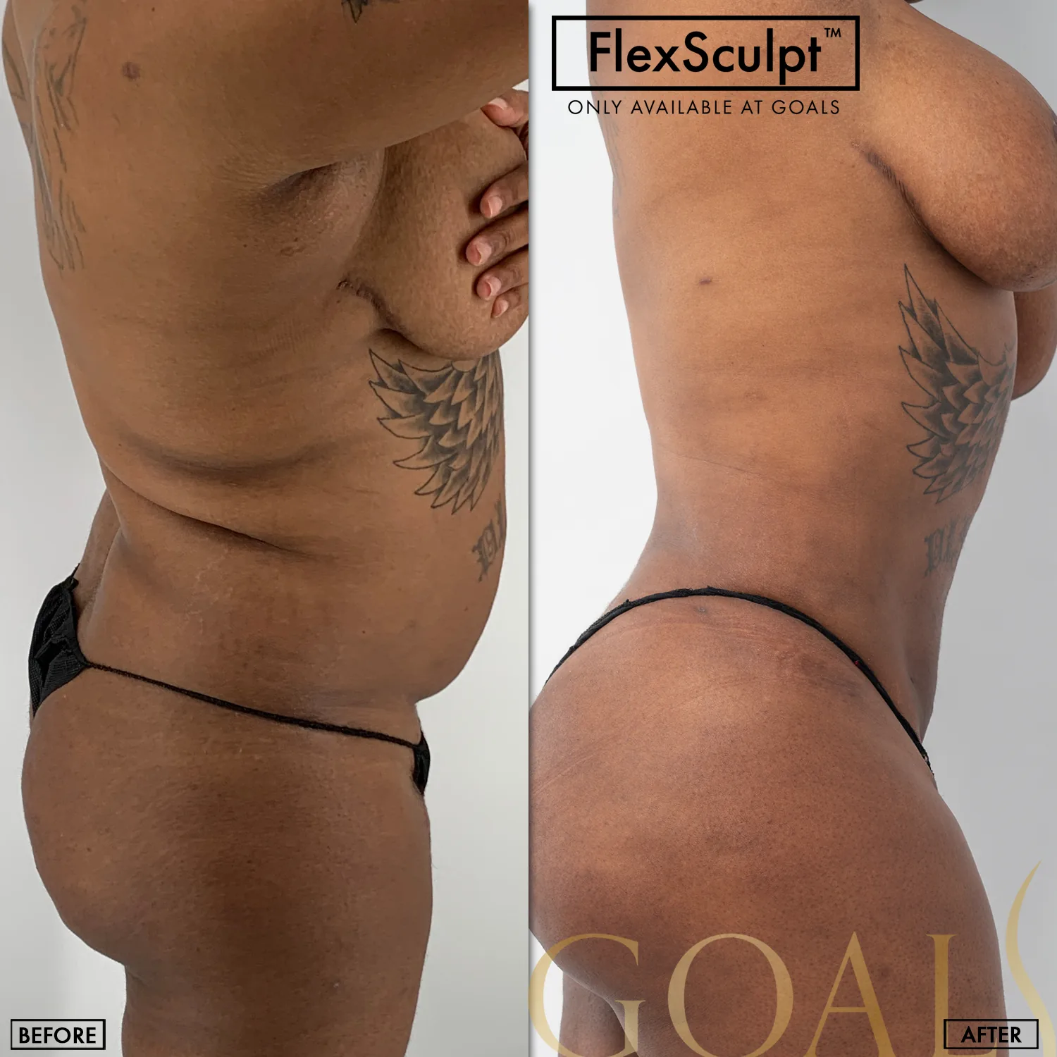 Before and after — Awake Liposuction with FlexSculpt · Ridgefield, patient 2
