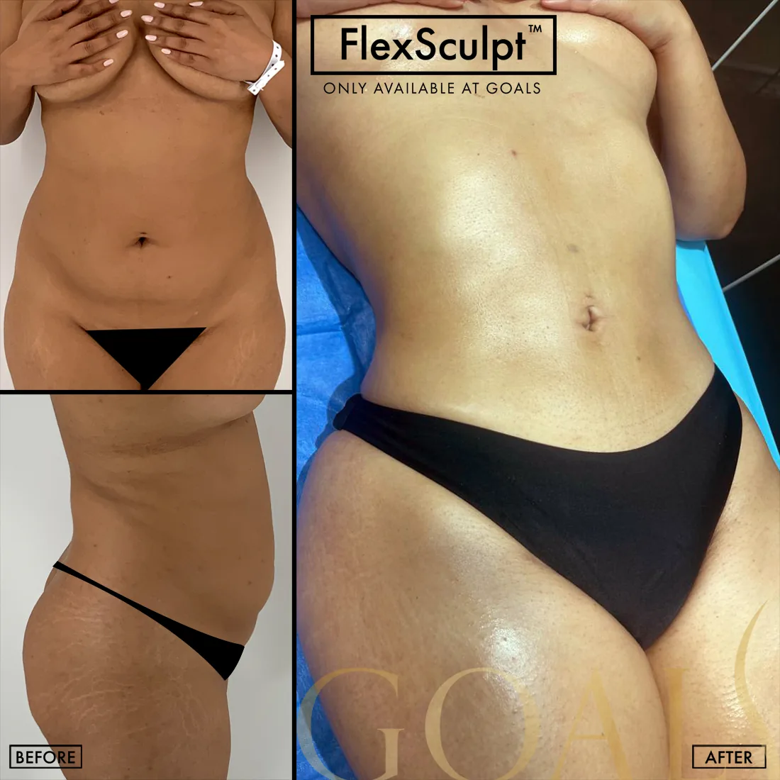Before and after — Awake Liposuction with FlexSculpt · Ridgefield, patient 4