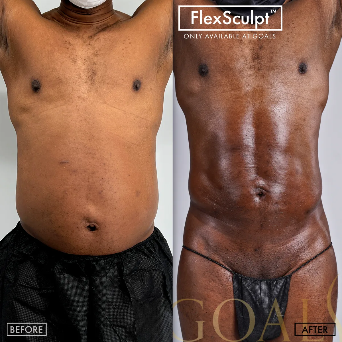 Before and after — Awake Liposuction with FlexSculpt · Ridgefield, patient 5