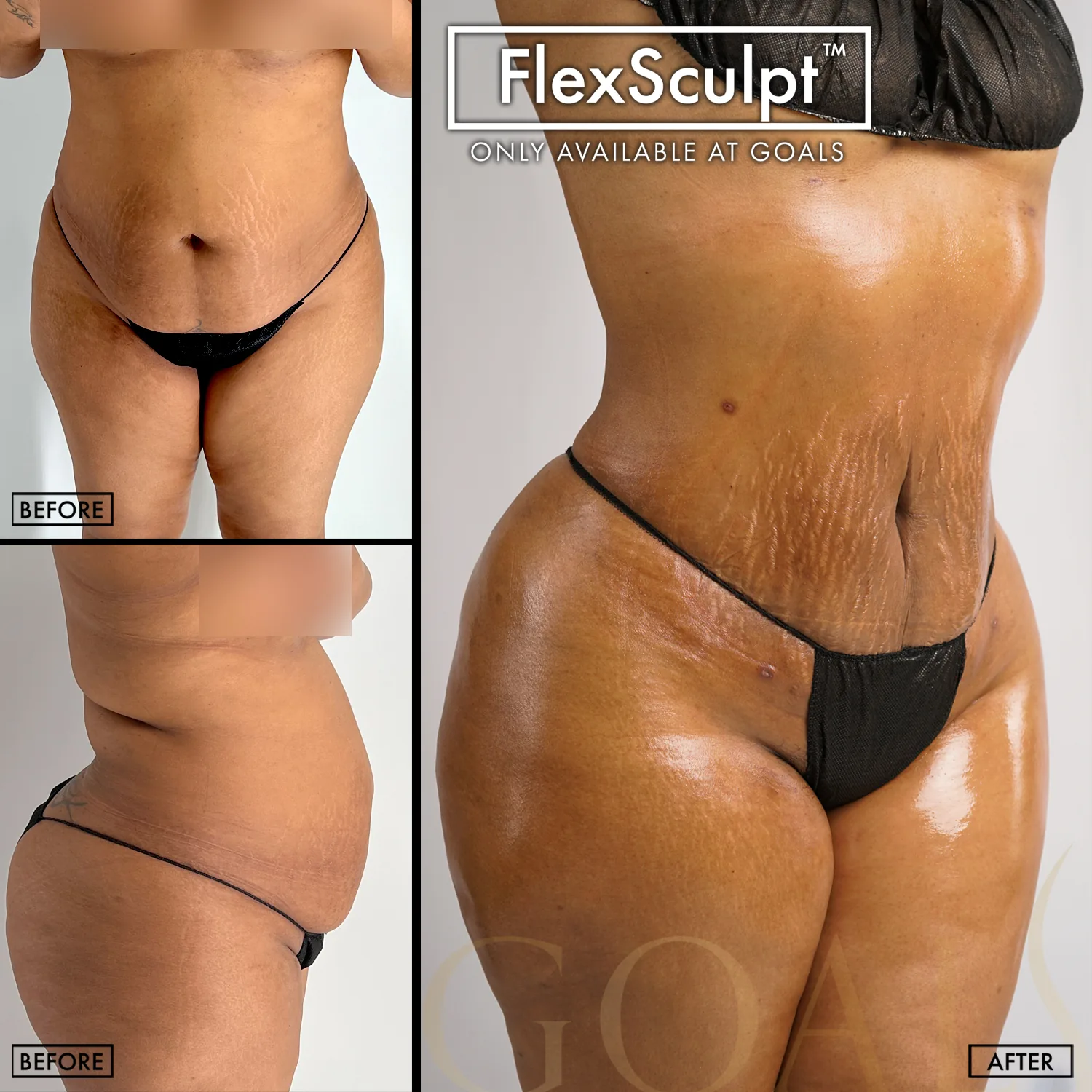 Before and after — Awake Liposuction with FlexSculpt, patient 3