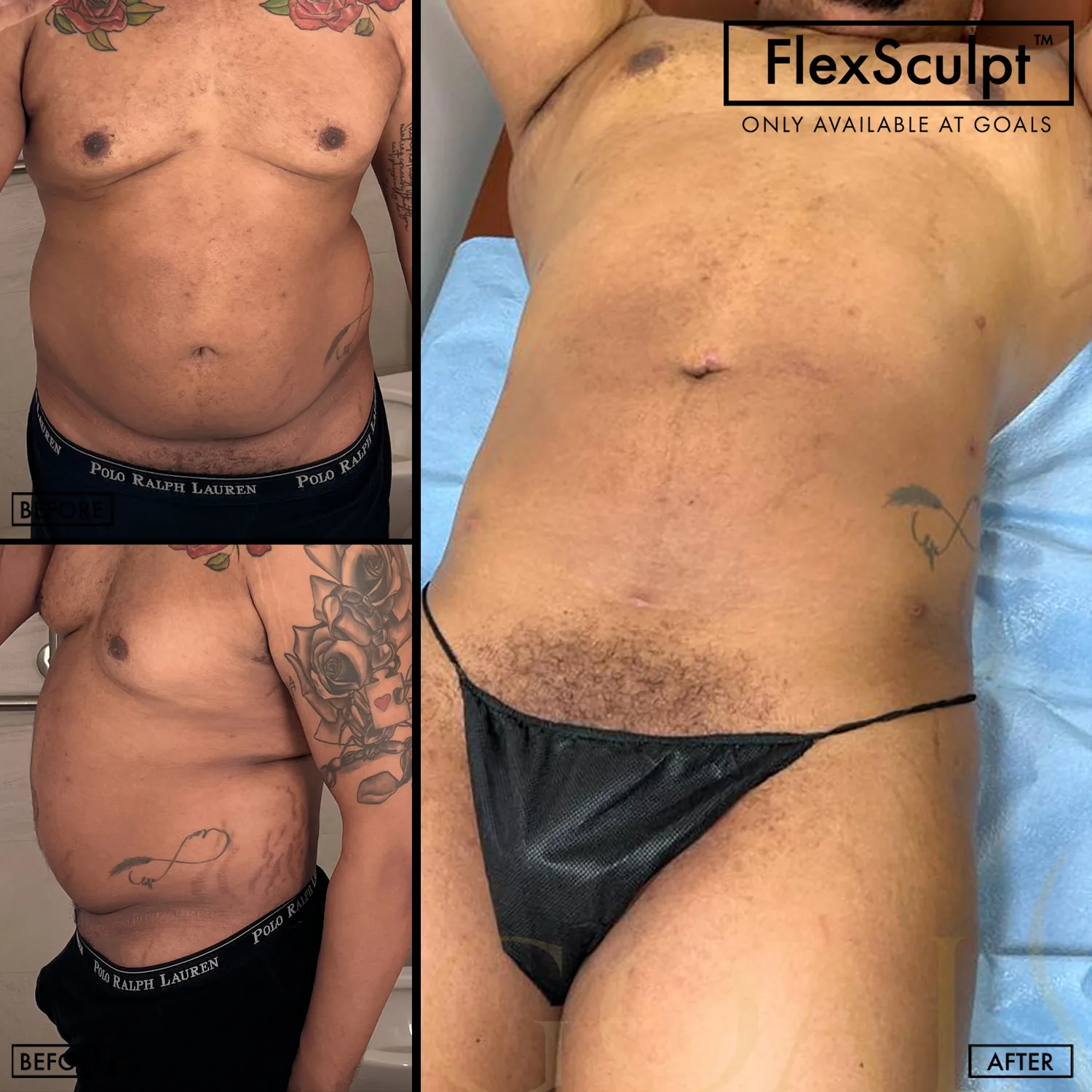 Before and after — Awake Liposuction with FlexSculpt · Houston, patient 1