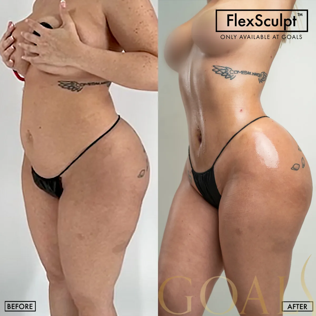 Before and after — Awake Liposuction with FlexSculpt · Houston, patient 2