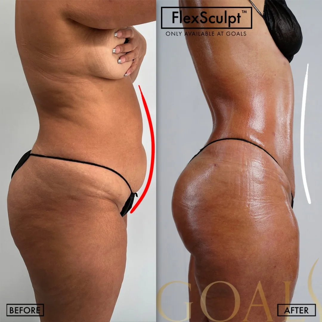 Before and after — Awake Liposuction with FlexSculpt · Houston, patient 3