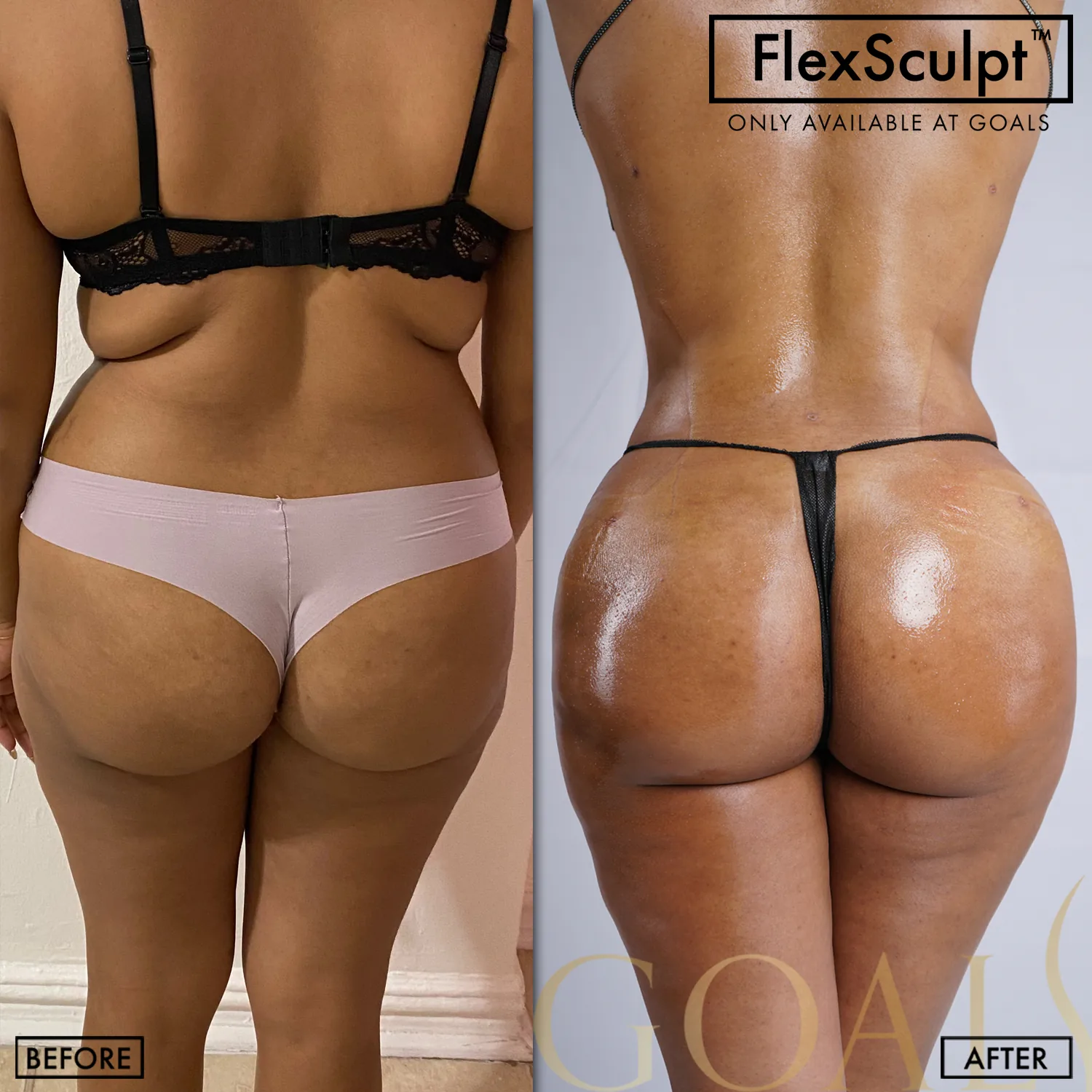 Before and after — Awake Liposuction with FlexSculpt · Houston, patient 4