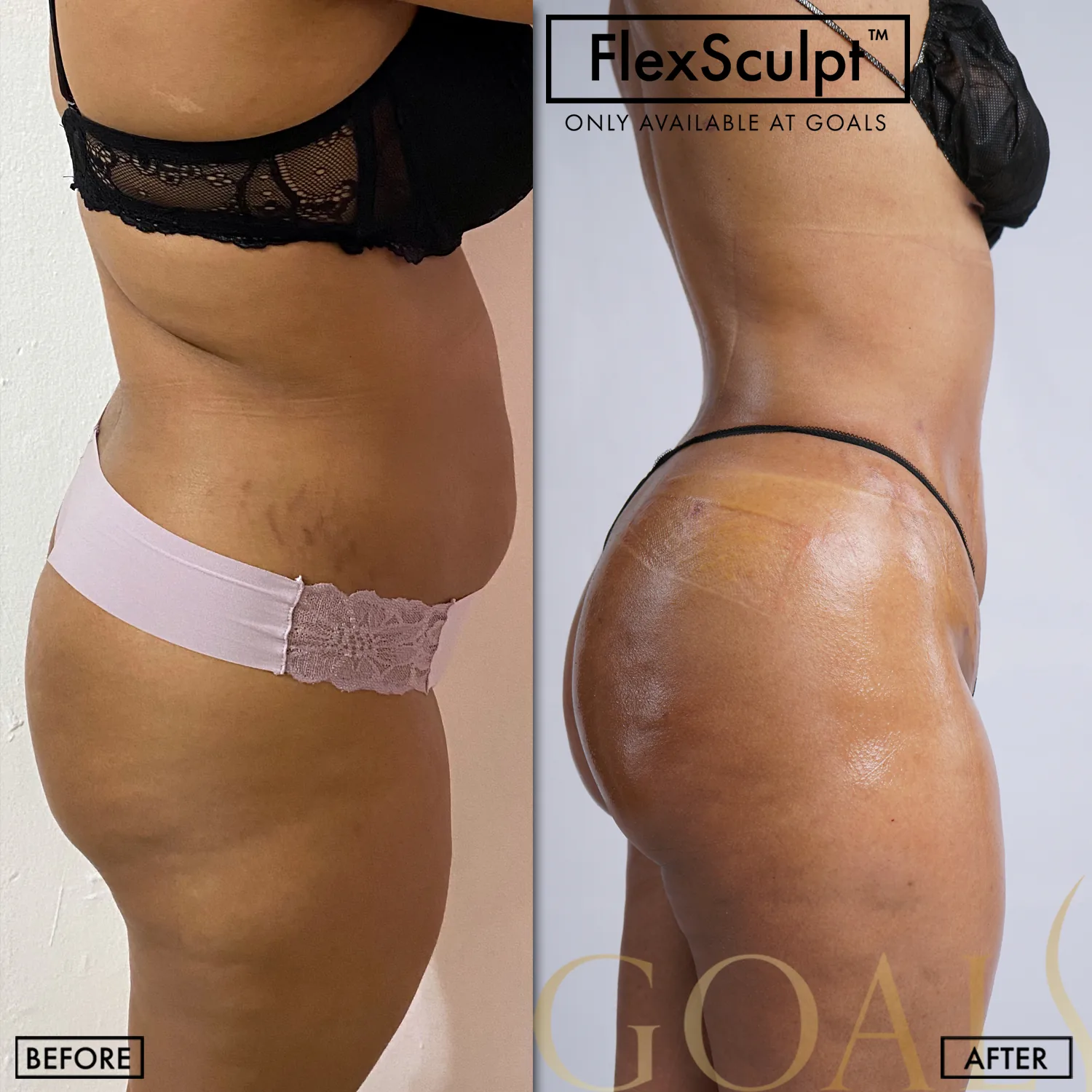 Before and after — Awake Liposuction with FlexSculpt · Houston, patient 5