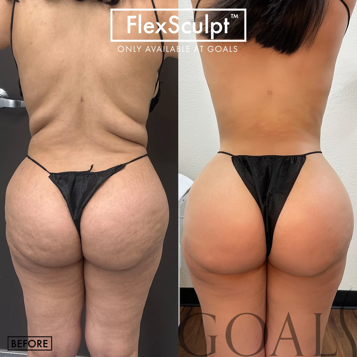 Before and after — Awake Liposuction with FlexSculpt · Houston, patient 6