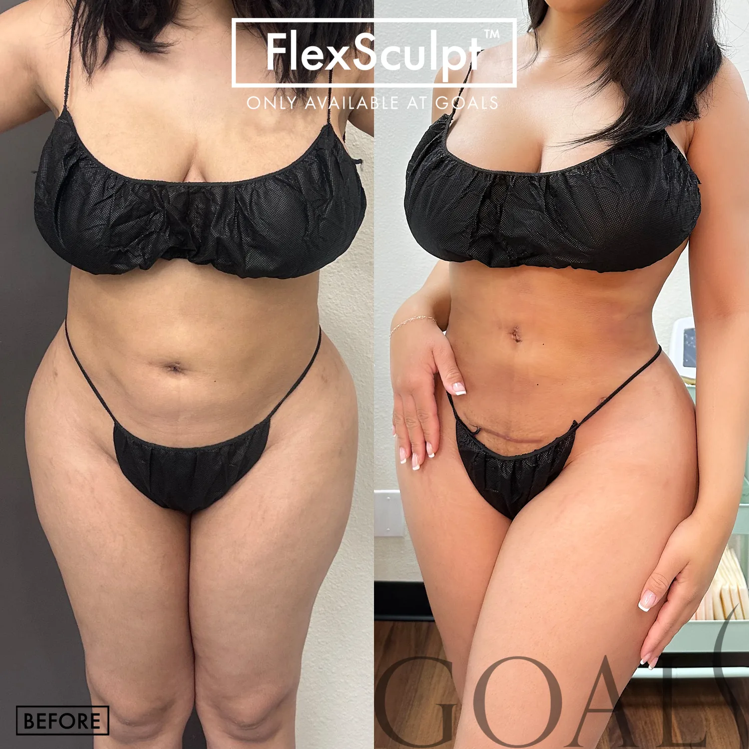 Before and after — Liposuction with FlexSculpt, patient 1