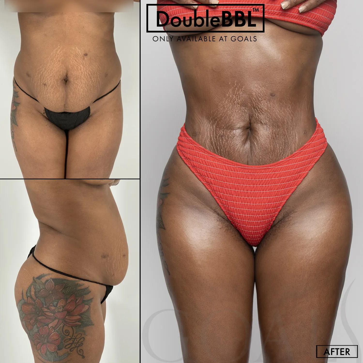Before and after — FlexTuck, patient 2