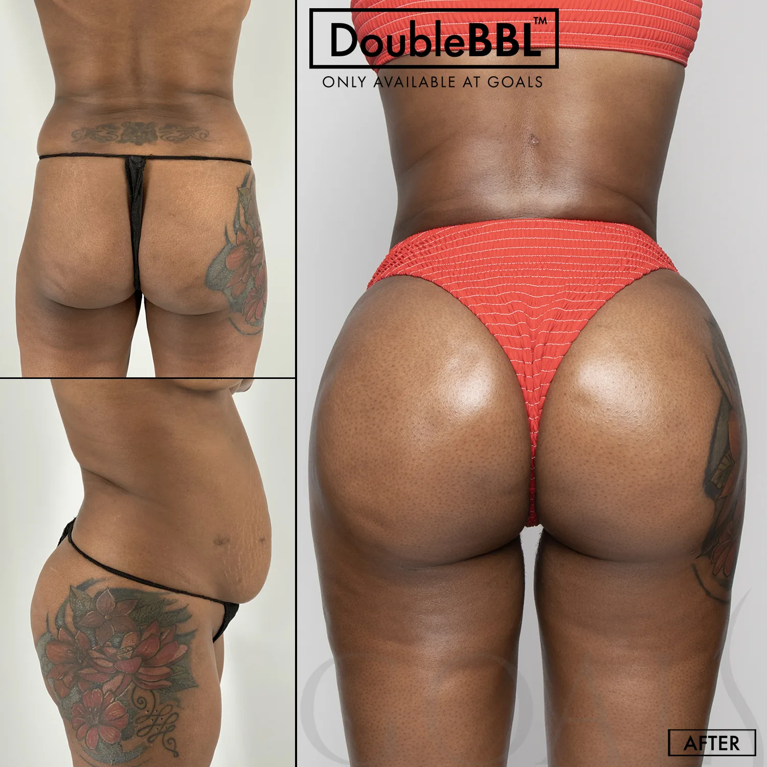 Before and after — FlexTuck, patient 1