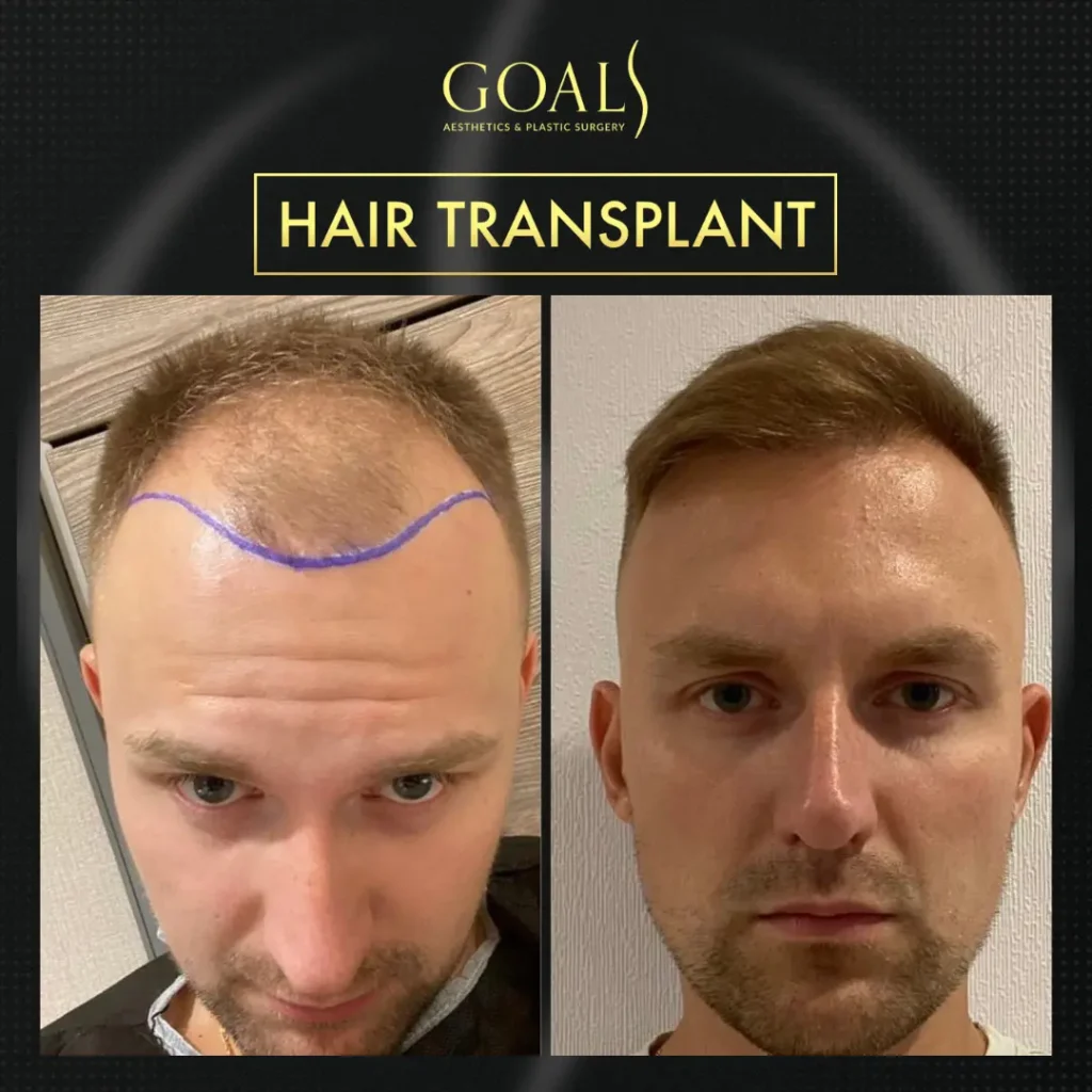 Antes y después de Trasplante Capilar FUE