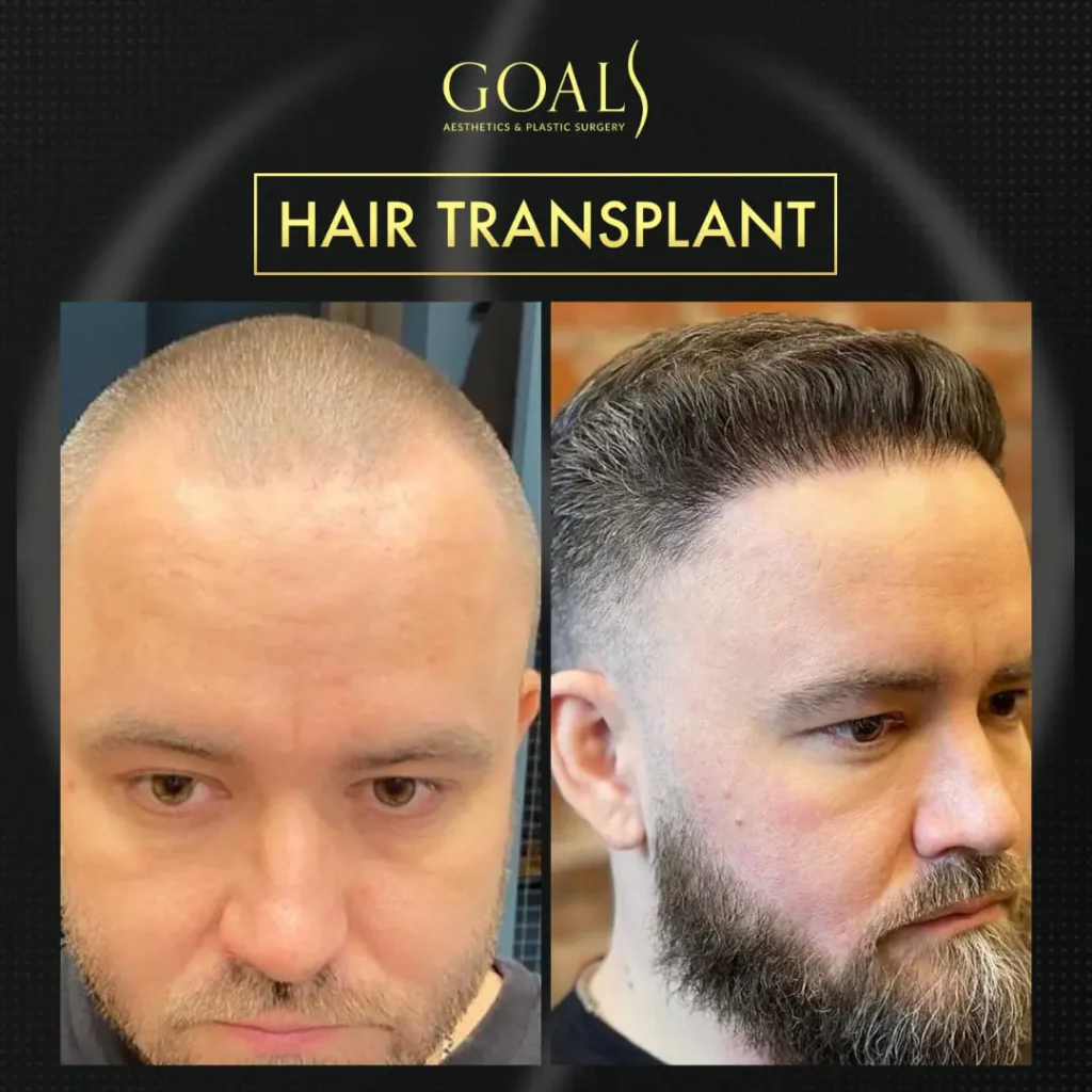 Antes y después de Trasplante Capilar FUE