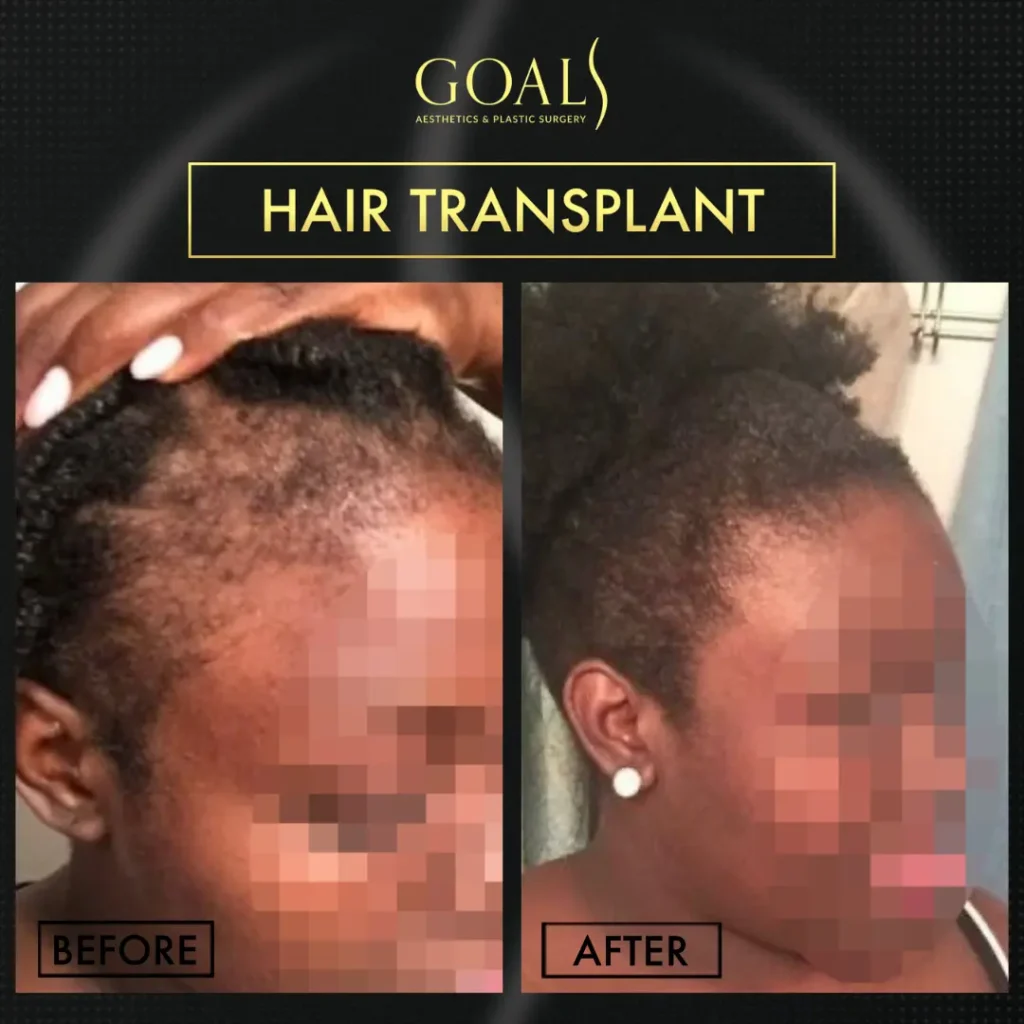 FUE Hair Transplant — patient result