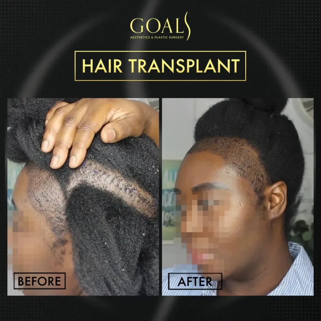 Before and after — Trasplante Capilar FUE, patient 1