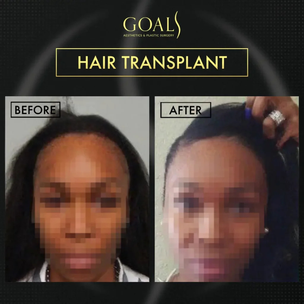 Before and after — Trasplante Capilar FUE, patient 3