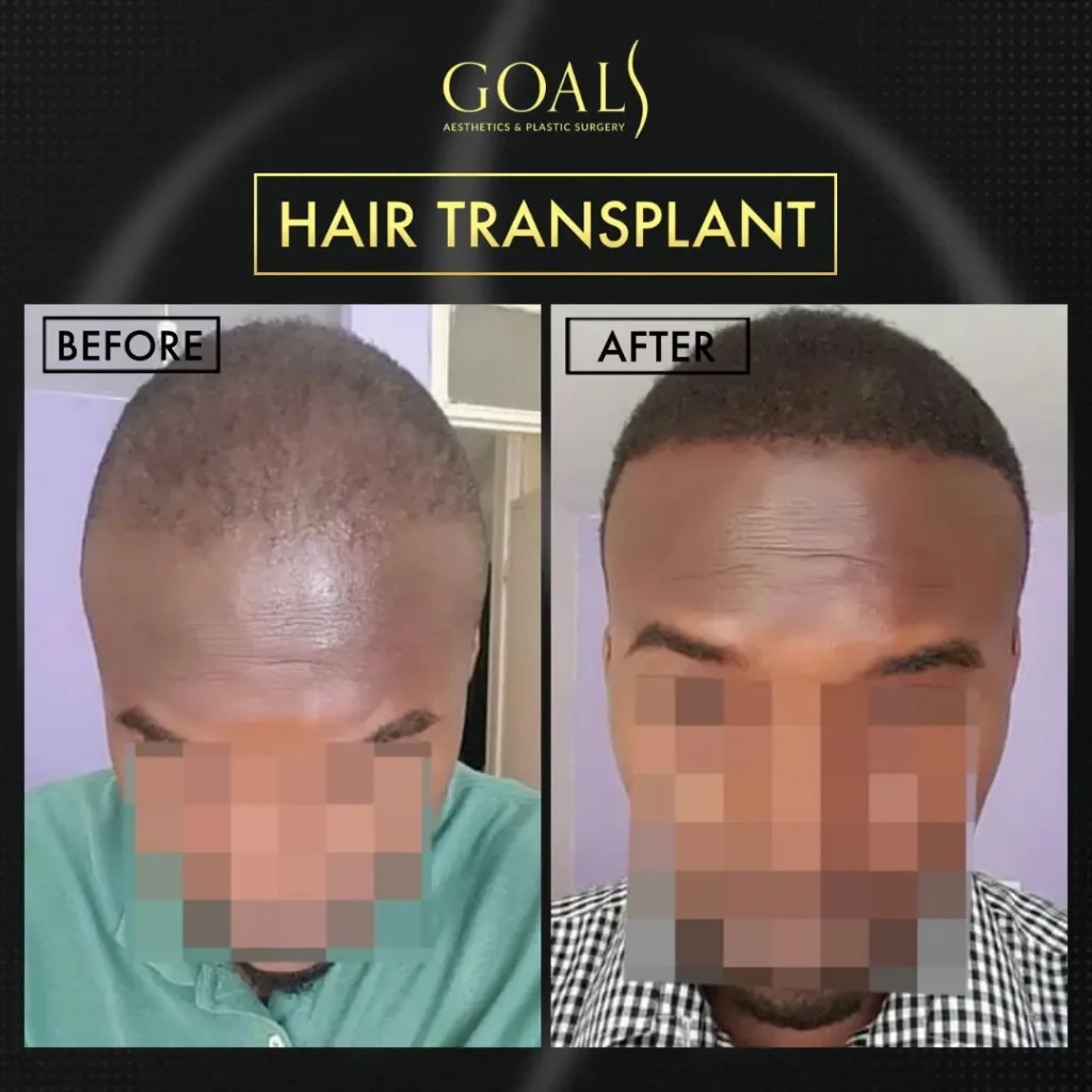 Before and after — Trasplante Capilar FUE, patient 4